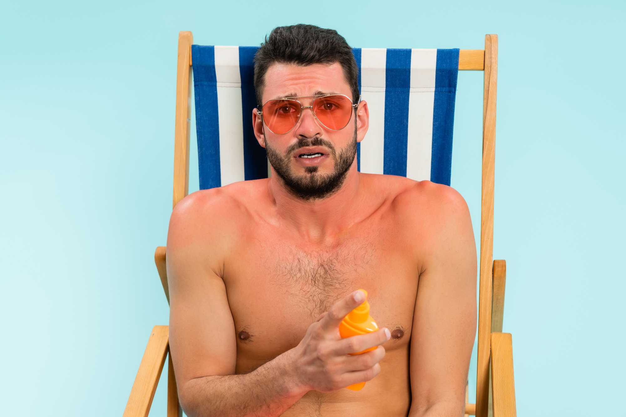 Sunburn. A man applying suntan lotion to prevent burning in the sun.