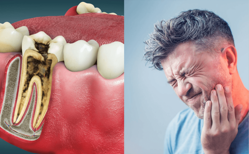 Link between Root Canals and health in Chelan, Wa.